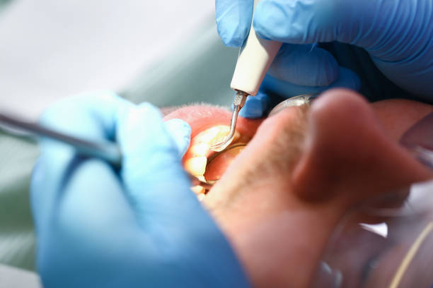 Best Emergency Root Canal Therapy in East Richmond Heights, CA