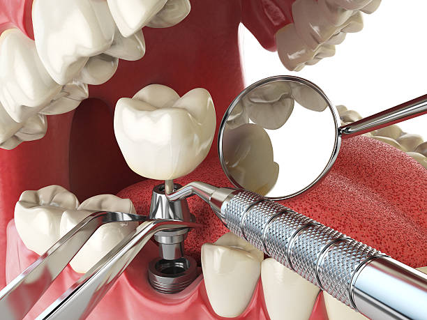 Best Emergency Wisdom Tooth Extraction in East Richmond Heights, CA